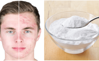 How to cure acne with baking soda?